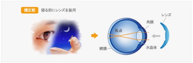 オルソケラトロジーの仕組み01