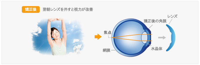 オルソケラトロジーの仕組み03