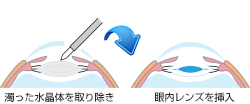 白内障イラスト